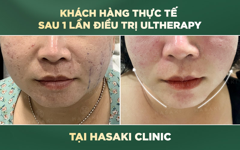 Trải nghiệm của khách hàng về dịch vụ Ultherapy tại Hasaki Clinic