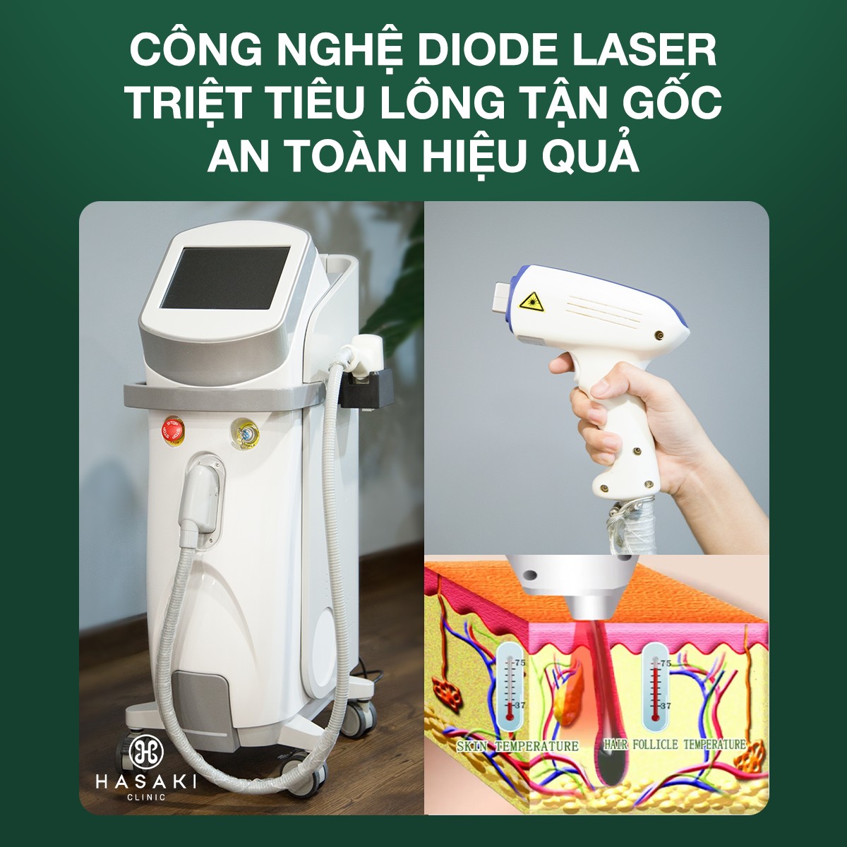 tẩy lông chân tại nhà công nghệ diose laser