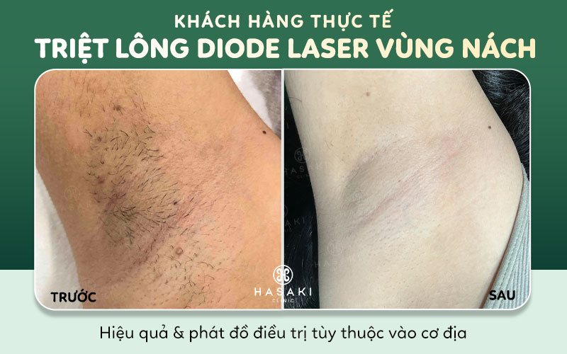 Hiệu quả triệt lông công nghệ Diode Laser tại Hasaki Clinic