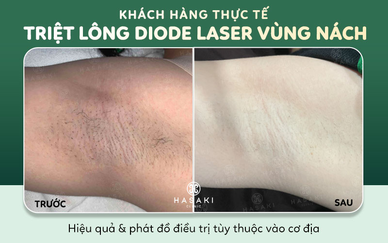 Hiệu quả triệt lông công nghệ Diode Laser tại Hasaki Clinic 