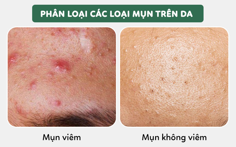 Phân loại các loại nặn mụn trên da