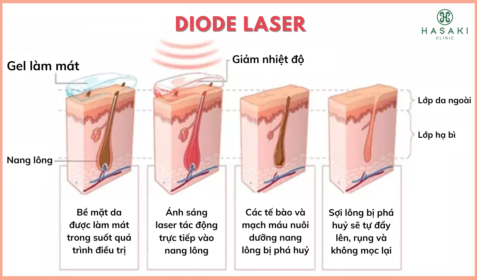 Triệt Lông Diode Laser không đau không rát