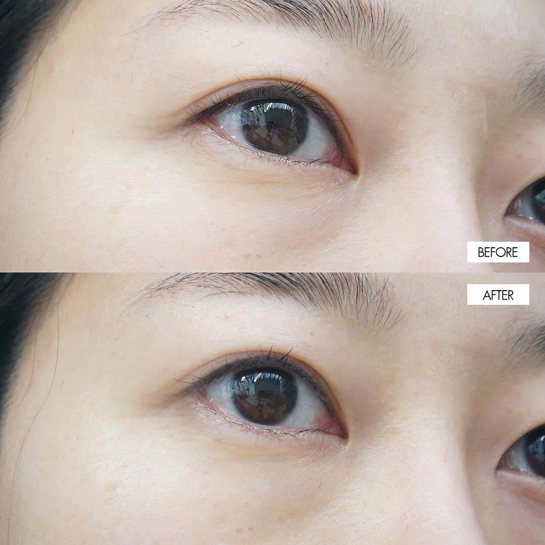 Kem Dưỡng Mắt Sur.Medic+ Perfection 100™ All In One Facial Eye Cream 35ml