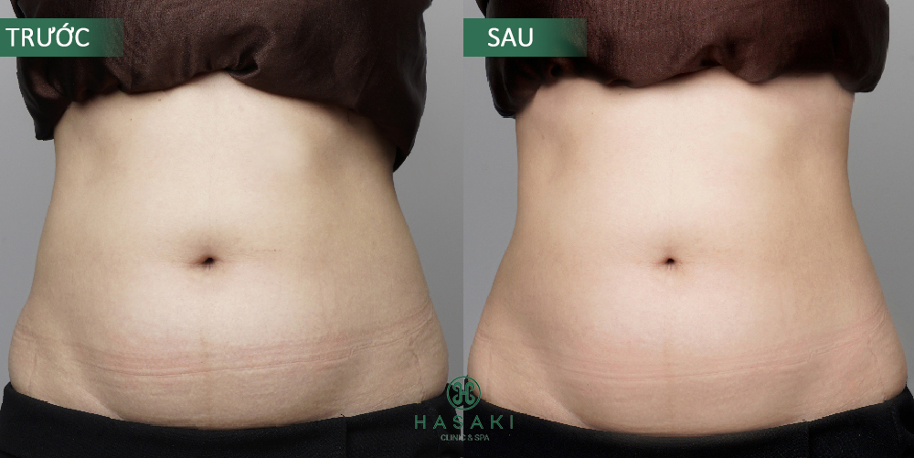 Giảm béo S-Line chuyên sâu tại Hasaki Clinic & Spa
